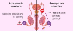 Azoospermia secretoria e ostruttiva